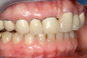 photo_metalfree-1
